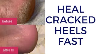 How to Quickly Heal Cracked Dry Feet & Heels Naturally | DIY Natural Treatment for Cracked Heels