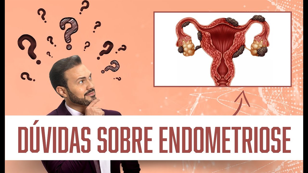 DÚVIDAS DE PROFISSIONAIS DA SAÚDE SOBRE ENDOMETRIOSE |  Dr. André Vinícius