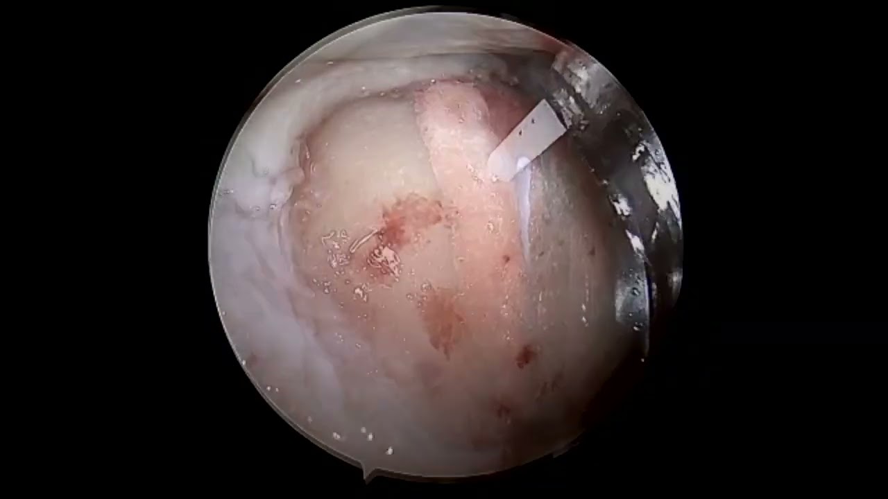 Largest MACI Arthro performed in the US