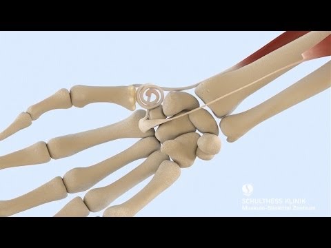 «Behandlung Daumensattelgelenk-Arthrose» - Schulthess Klinik