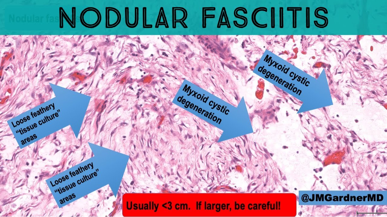 Nodular fasciitis 101 - tips & tricks for diagnosis (pathology dermpath dermatology)