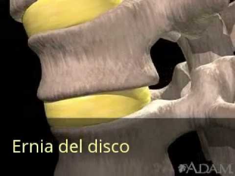 Borsite degli esercizi ginocchio Mal di schiena può fare sport