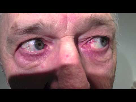 Positive Head Impulse Test 4