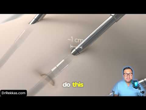 Robotic hernia repair video thumbnail