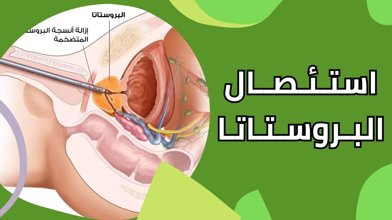 استئصال البروستاتا وأثرها على الانتصاب والقذف ونقص هرمون الذكورة