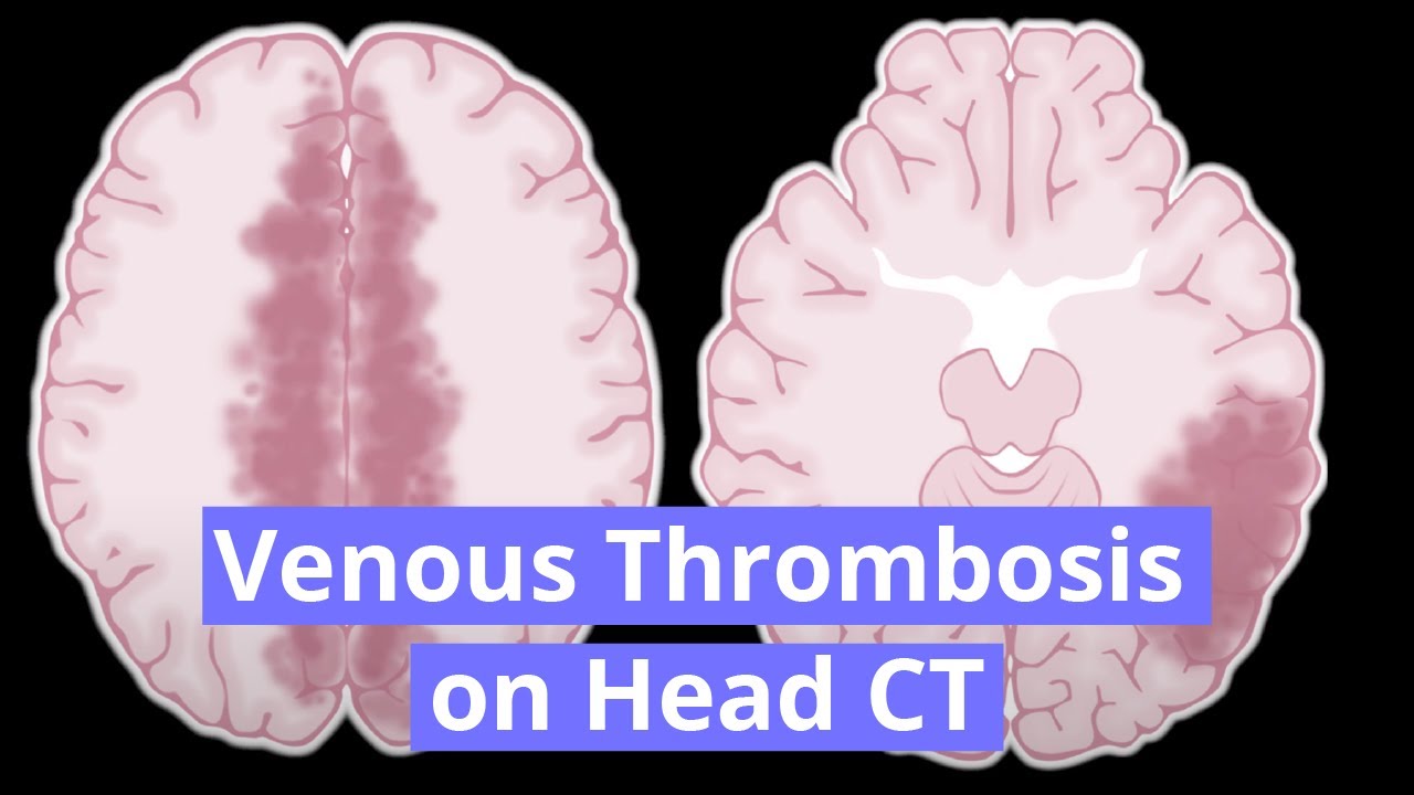 Cerebral Venous Thrombosis
