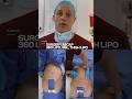 360 Lipo BBL Results You Won T Believe Stunning Before After
