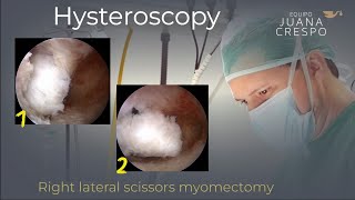 Right lateral myomectomy (Scissors)