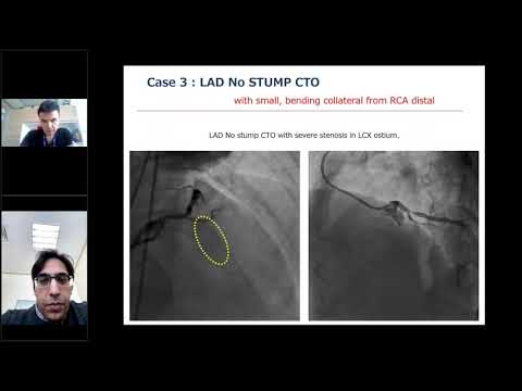 Retrograde CTO Technique: What is essential?
