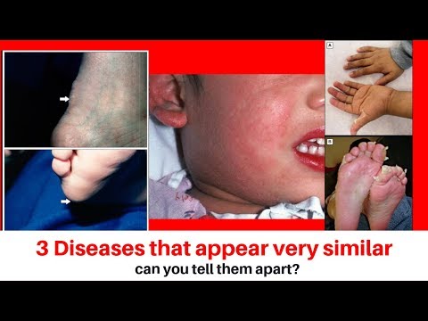 Kawasaki disease, scarlet fever, and rheumatic fever