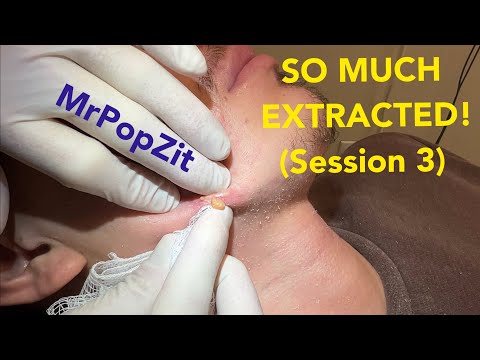 So many pops! See his transformation, previous videos linked in description! Extractions session 3.