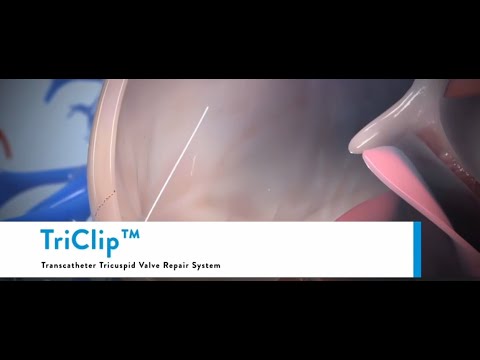 Triclip (Transcatheter Tricuspid Valve Repair System) - Tricuspid valve regurgitation
