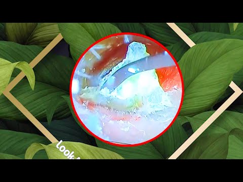 귀지 제거 만족 ear wax removing satisfying
