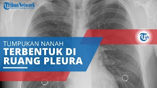 Empiema, Penyakit yang Menyebabkan Adanya Tumpukan Nanah yang Terbentuk di Ruang Pleura