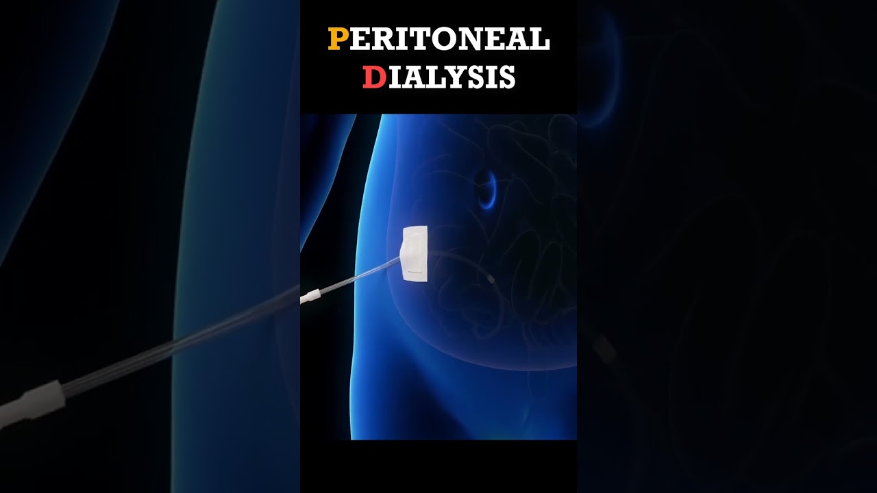 Peritoneal Dialysis Procedure #shorts #dialysis