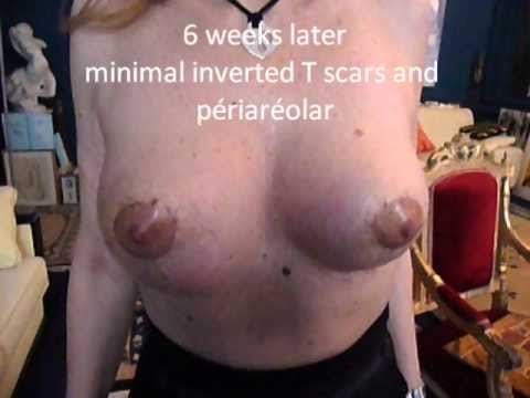comment reparer une ptose mammaire