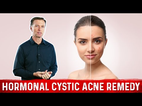 Best Remedy for Hormonal Cystic Acne – Dr.Berg