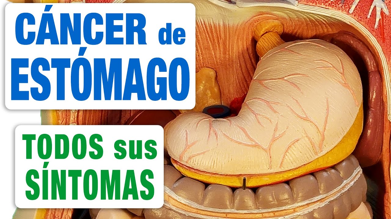 Todos los Síntomas del Cáncer de Estómago