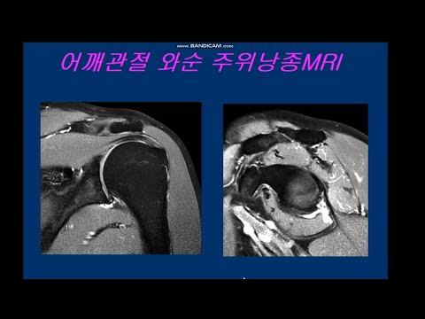 어깨관절 와순 주위낭종MRI
