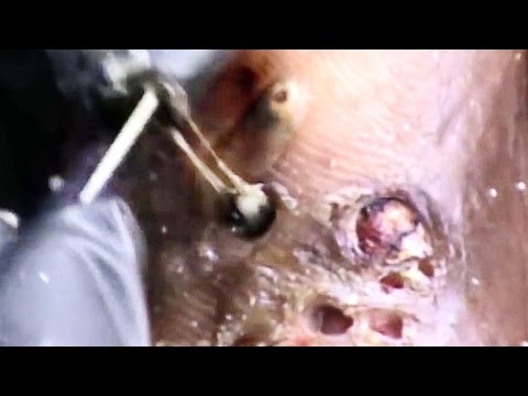 Targhe universali contro vermi I parassiti che vivono in un crasso