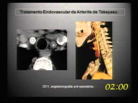 Resultados do tratamento endovascular na arterite de Takayasu.