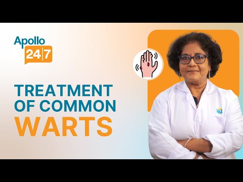 How to Get Rid of Warts Masse Dr Srabani Ghosh Zoha