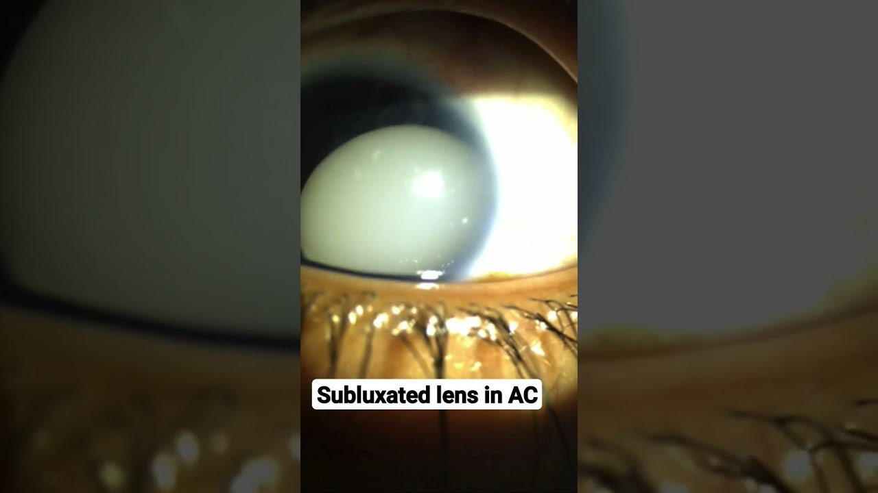 SUBLUXATED LENS IN AC