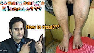 Schamberg’s disease/treatment/prevention ( black spots on legs (पाँव में काला दाग)