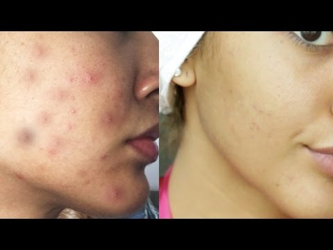 How to Get Rid of Acne in ONE WEEK