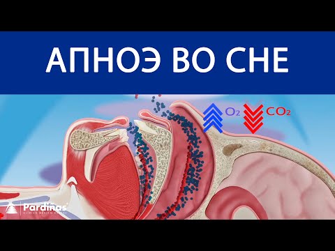 Апноэ во сне ©