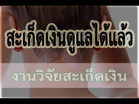 ตัวเอง disgidroticheskaya กลาก ทั้งหมดกลากจุลินทรีย์