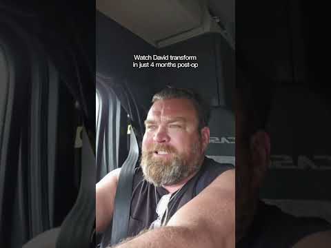 David’s 4-Month Transformation After Gastric Sleeve Surgery in Tijuana, Mexico at Hospital CYNTAR