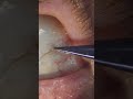 Sub Conjunctival Eyelash Removal Shorts