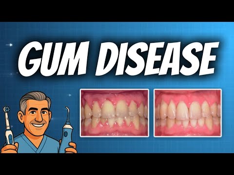 Gum Disease