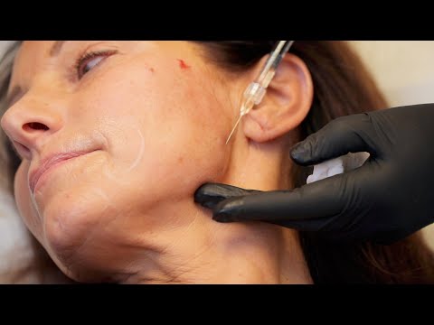 Dr. Natalie Keller – Hyaluronic acid treatment for the aging face | Live treatment in Osnabrück