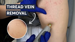 Unbelievable Way to Get Rid of Thread Veins - Results You Won