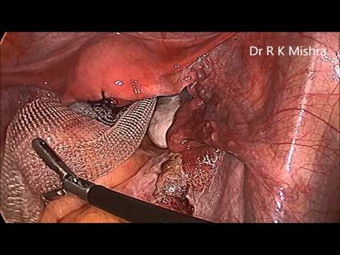 Laparoscopic Sacrocolpopexy for Vault Repair
