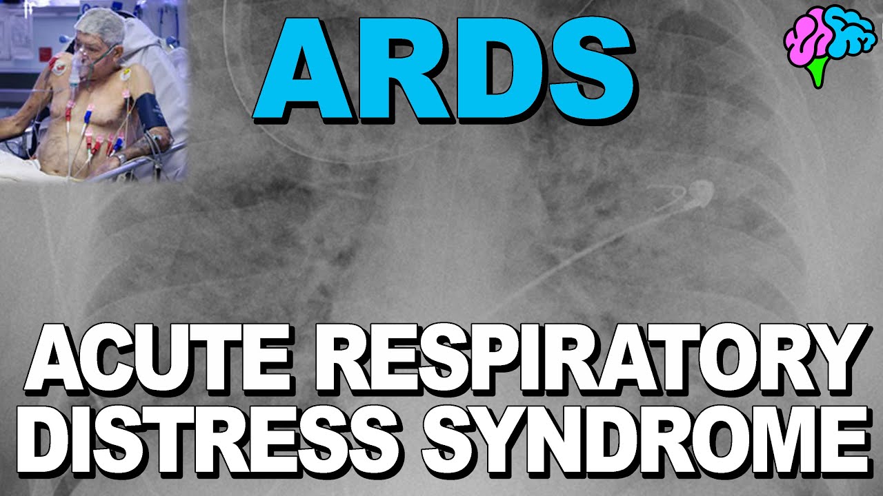 What is ARDS? Acute Respiratory Distress Syndrome