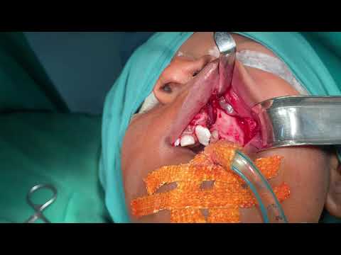 Secondary Alveolar Bone Grafting