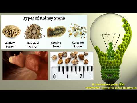 Kidney Stones Treatment Chennai Dr Sheela Homeopathy