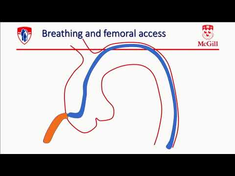 Radial CTO PCI - Stéphane Rinfret, MD