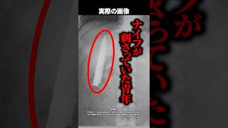 【衝撃】胸の奥にナイフが刺さったまま1年以上生活！？→健康診断で発覚した信じられない理由とは #shorts