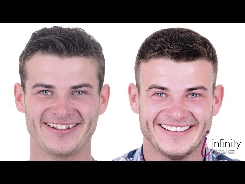Carillas dentales, la solución definitiva Carillas dentales, la solución definitiva