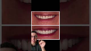 VENEERS Gone Wrong! #shorts