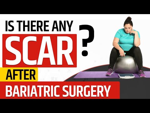 Is There Any Scar After Post Bariatric Surgery | Bariatric Surgery Scars Solution