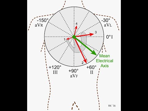 Determination of Mean QRS Axis in Electrocardiography