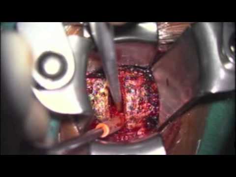 Anterior cervical fusion after discectomy