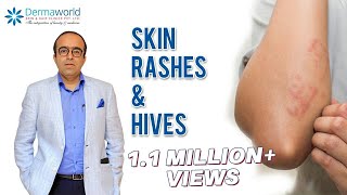 Why does Skin Rash, Hives, Urticaria happen? | Dr Rohit Batra explains