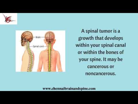 Treatment for Spinal Cord Tumor