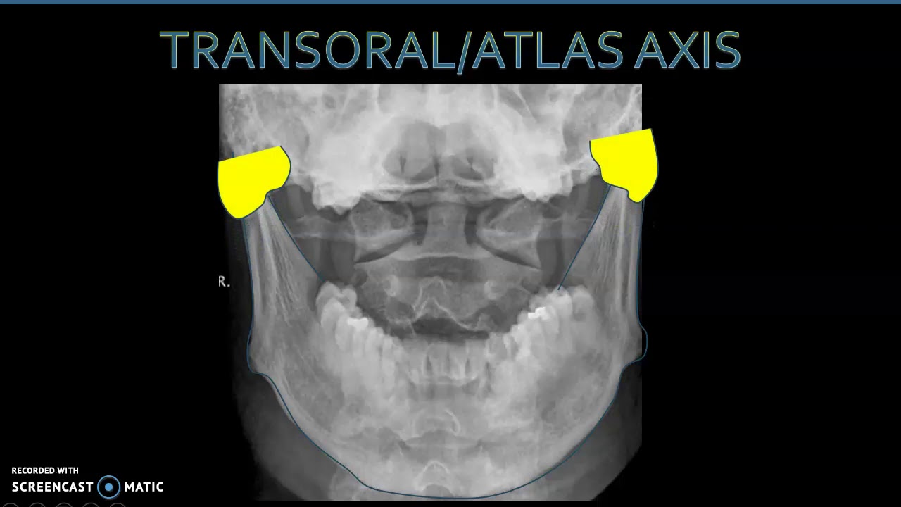 Anatomía Radiológica Columna Cervical 2